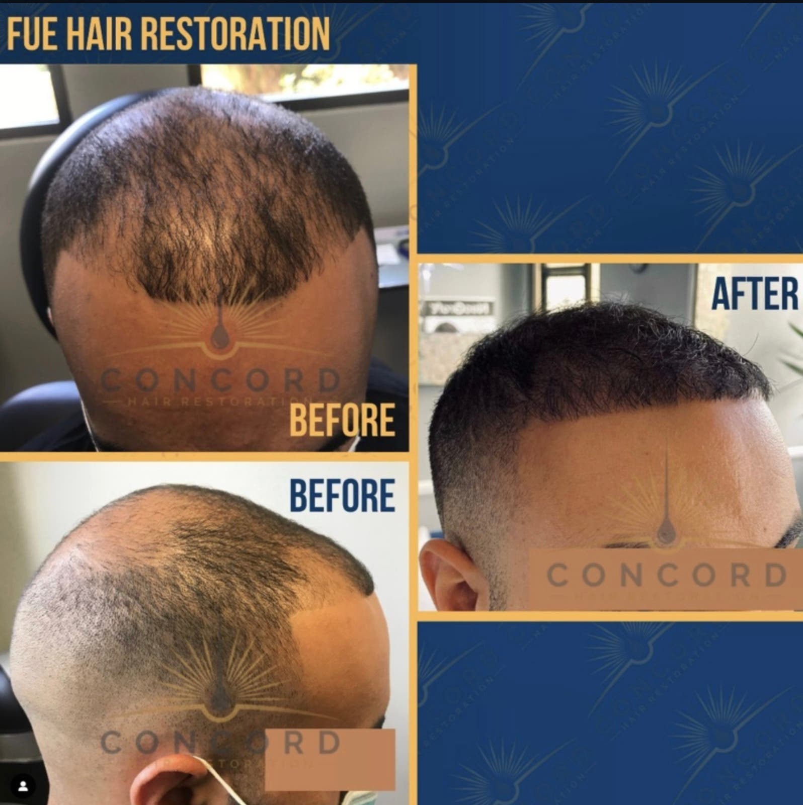 Considering a Hair Transplant in Los Angeles? What to Know Before Choosing a Clinic