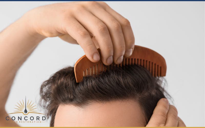 Considering a Hair Transplant in Los Angeles? What to Know About FUE Hair Restoration