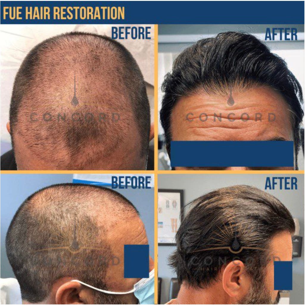 Considering a Hair Transplant in Los Angeles? Start Here