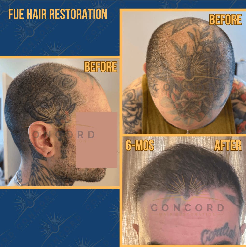 Considering a Hair Transplant in Los Angeles? Start With a Personalized Consultation