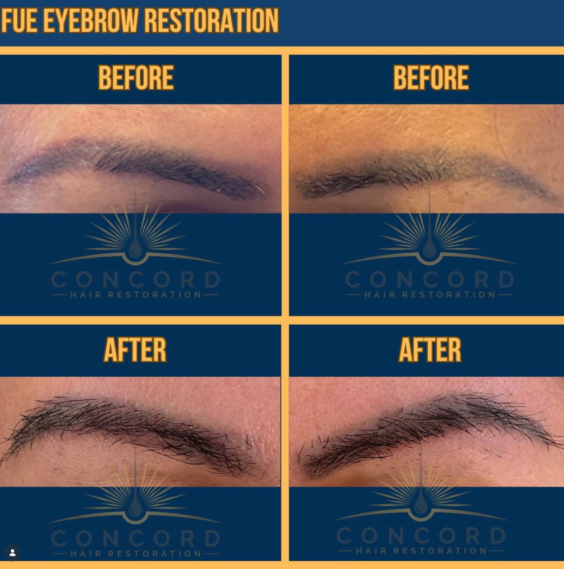 Eyebrow Transplants in Los Angeles | Natural-Looking Fuller Brows
