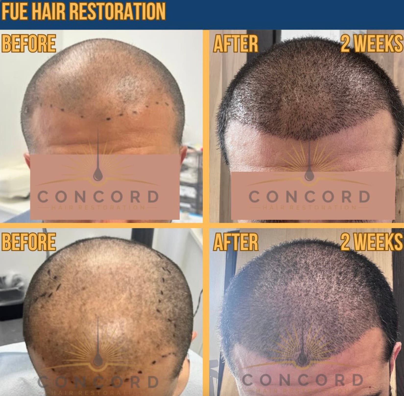 Hair Restoration Services in Los Angeles | FUE, NeoGraft & More