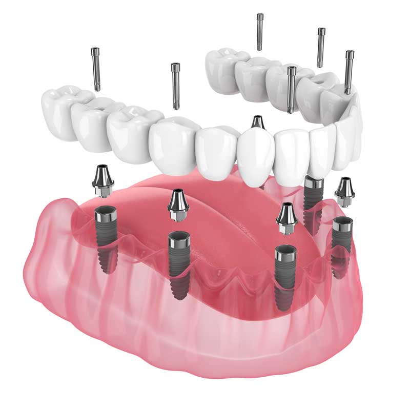 Trinity Dental Services Offers Full-Arch Implant Solution for East Brunswick Patients
