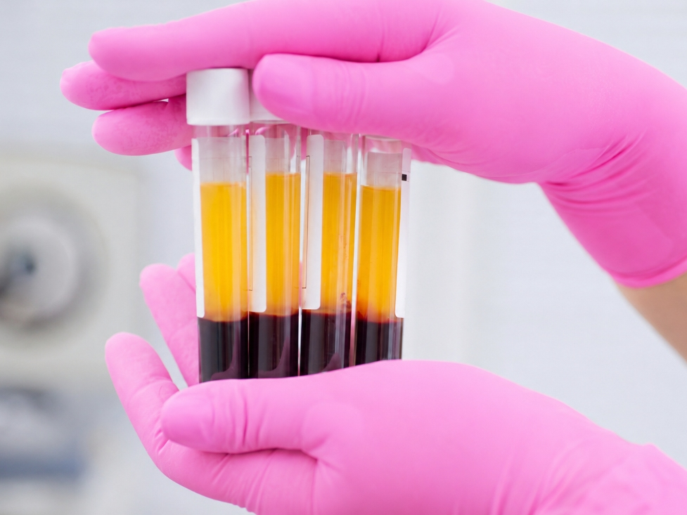 Platelet-rich plasma is prepared from the patient’s own blood for use in personalized PRP facial rejuvenation treatments.