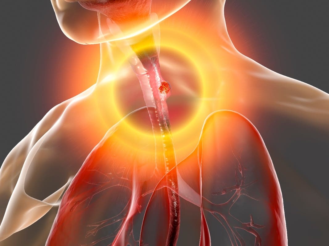 Esophageal cancer, illustration