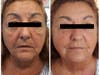 Before & after image after one icoone® LASER treatment