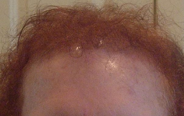 hair loss chemotherapy hair loss chemotherapy
