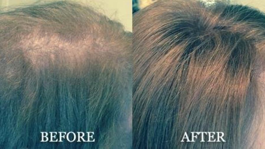 Before and after Suisse natural hair replacement Before and after Suisse natural hair replacement
