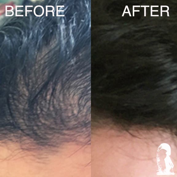 Hair Replacement for Women