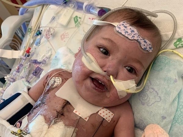 Parker always has a big smile on her face. At 13 months, she has undergone six open heart surgeries. 