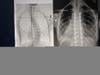 Image of Katherine's spine before and after surgery