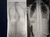 Image of Katherine's spine before and after surgery