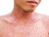 The New Jersey Health Department is warning residents of another possible measles exposure threat.