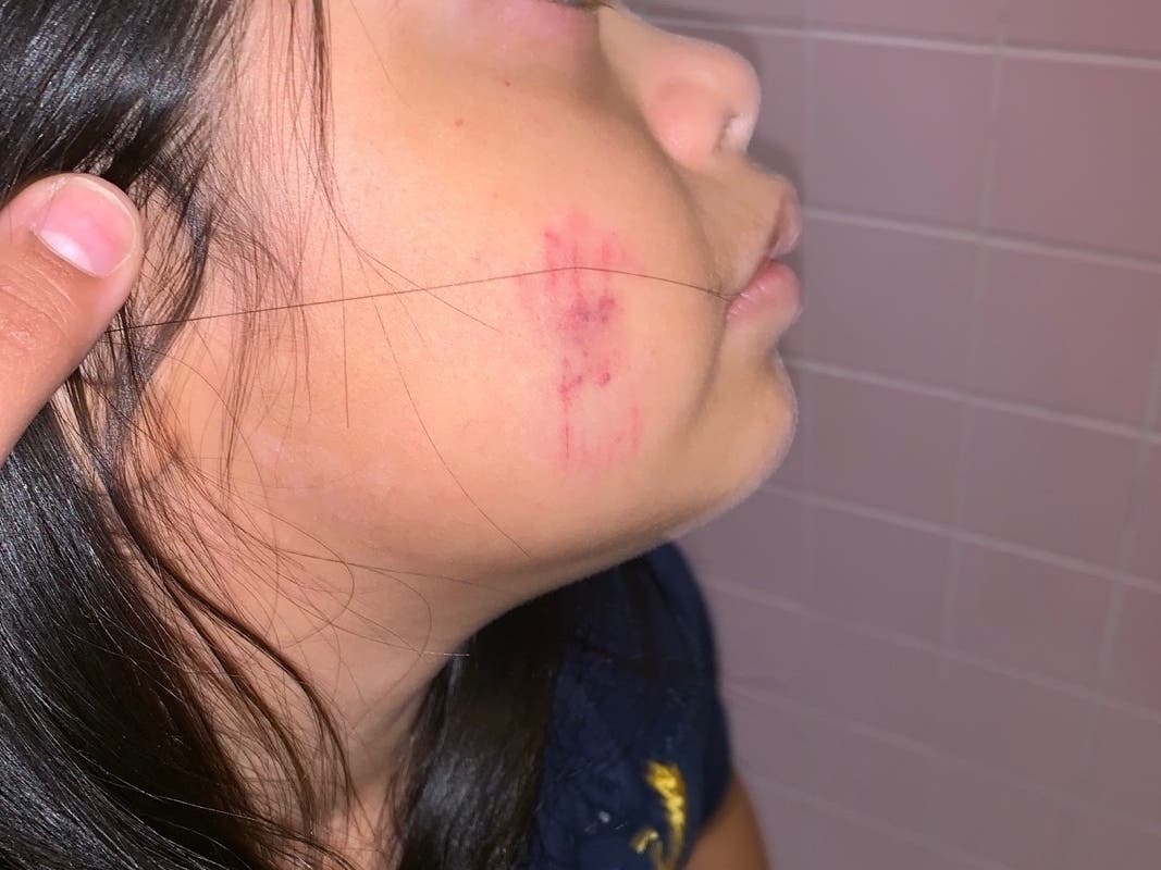 Emily, 8, came home with 6 bite marks, the family says.