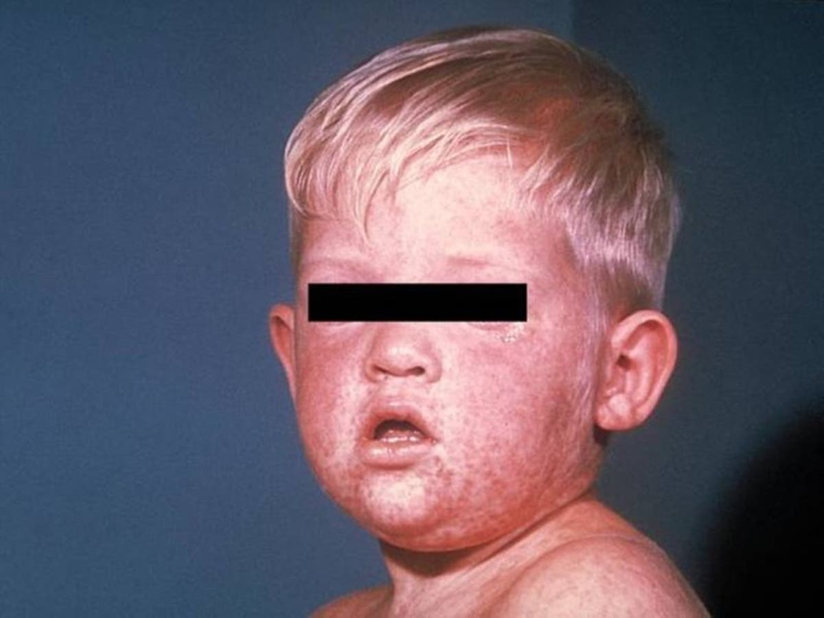 Another measles case has been confirmed in Rockland County.