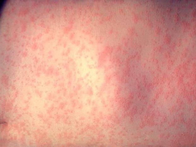 measles rash on an adult