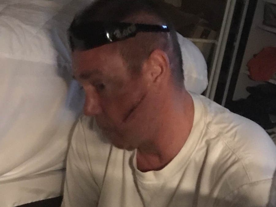 Brent Meldeau bears a scar from the March 2 attack when a man slashed him across the face with a machete in the Chatsworth Metro Station parking lot.