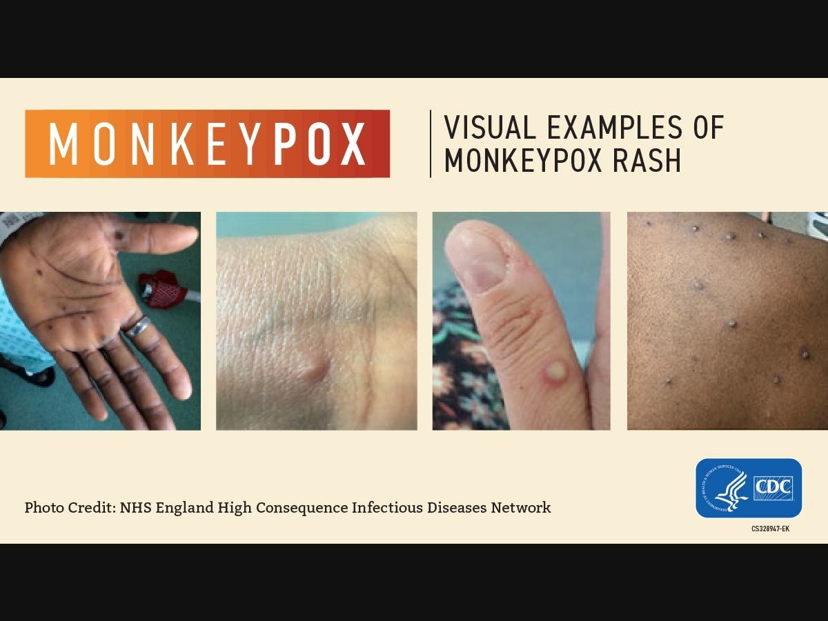 Examples of monkeypox lesions on infected people.