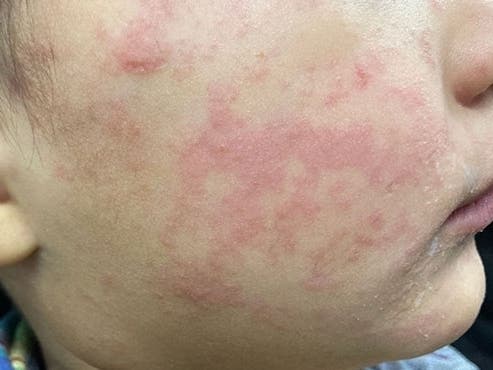 A child’s cheek shows the characteristic rash associated with measles. 